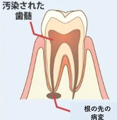 汚染された歯髄と根の先の病変