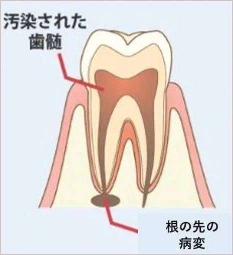 汚染された歯髄と根の先の病変
