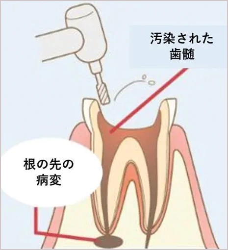 汚染された歯髄と根の先の病変