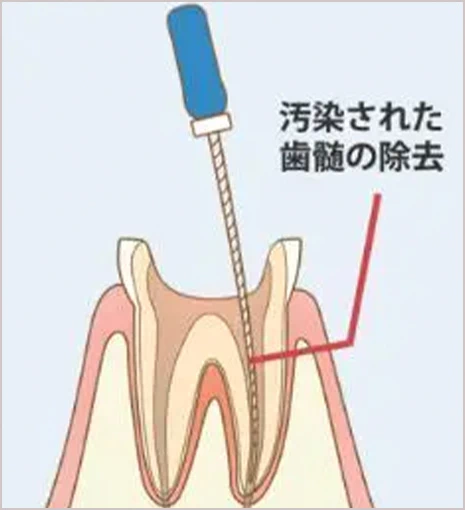 汚染された歯髄の除去